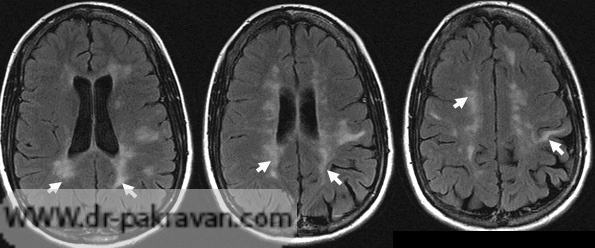 پلاک‌های سفید در MRI بیمار مبتلا به MS
